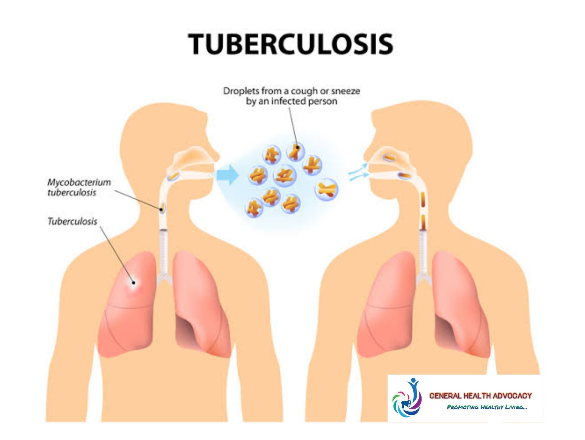 tuberculosis-tb-general-health-advocacy