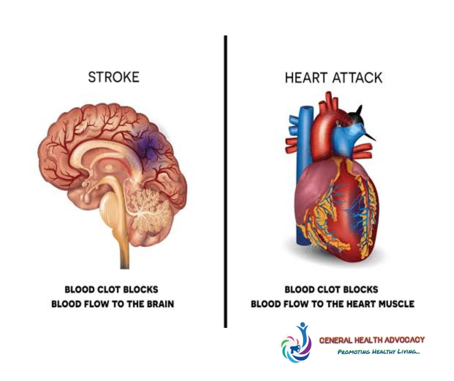 Is Heart Attack Pain Worse With Movement