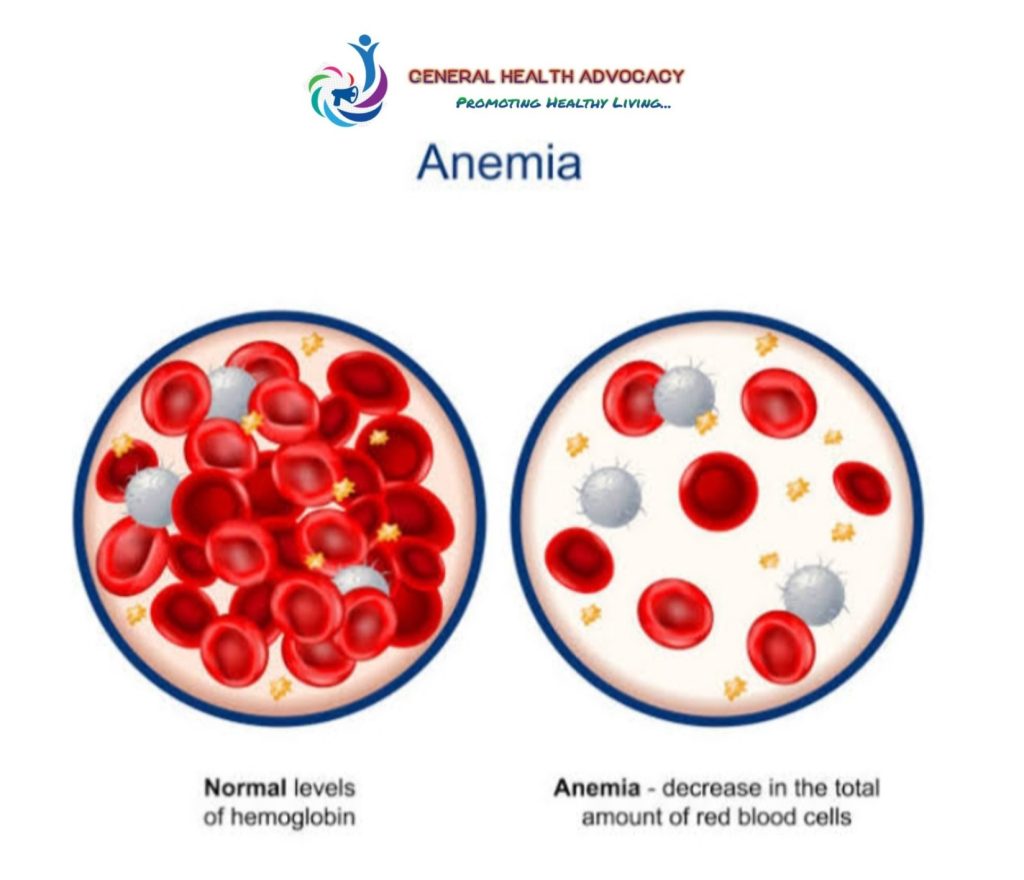 Anemia 