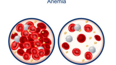 Anemia