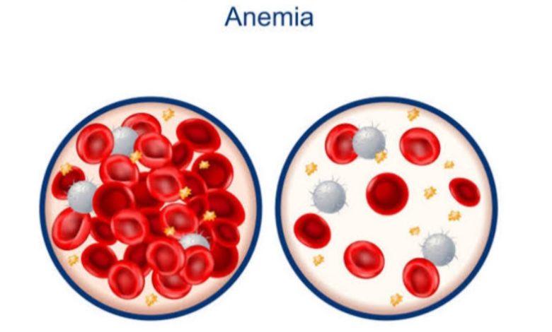 Anemia