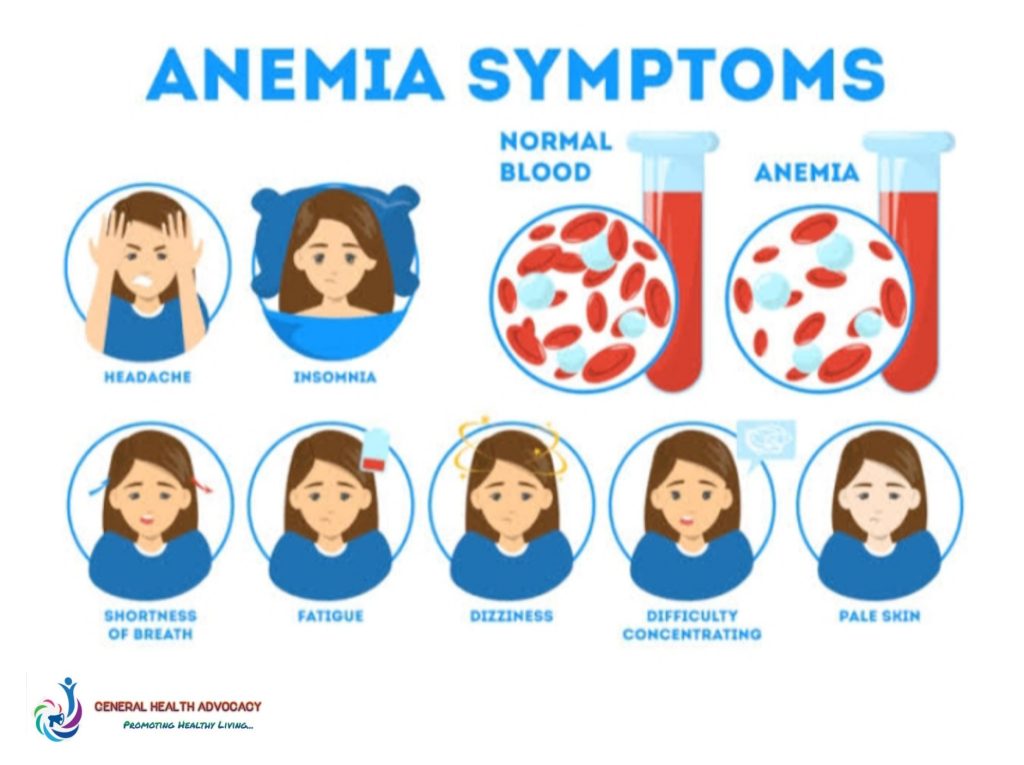 Symptoms and signs of Anemia 